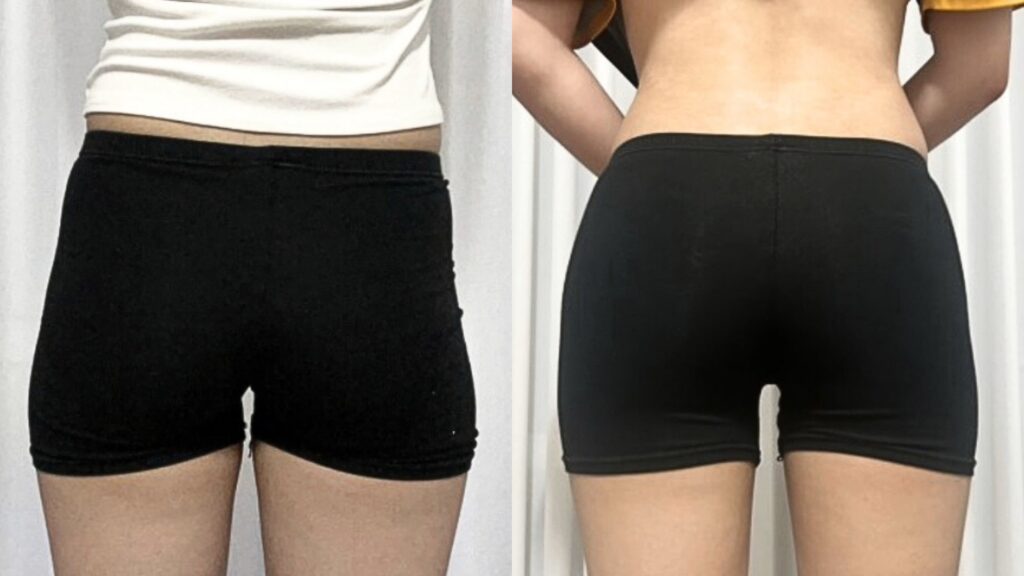 Buttock Lipofilling_ Photos Before and After