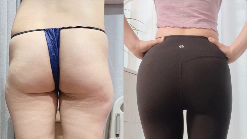 Buttock Lipofilling_ Transforming Figure and Enhancing Contours