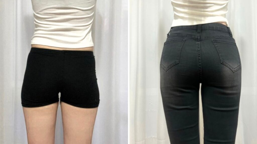 Buttock Shape Correction Through Lipofilling in Korea