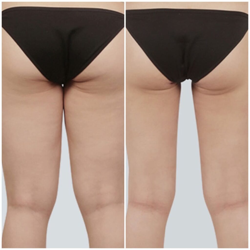 Calf Liposuction_ Outcome Photos in Korea