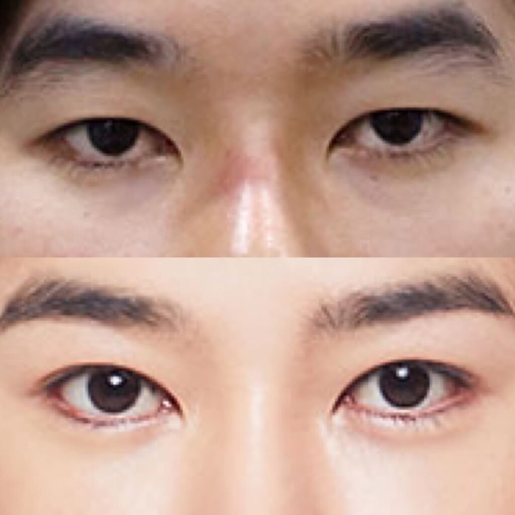 Canthoplasty Surgery Process in Korea