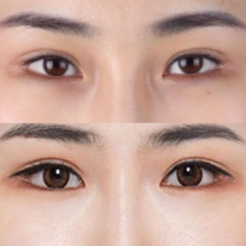 Canthoplasty Techniques in Korea