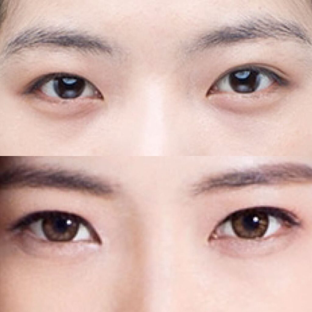 Canthoplasty for Eye Enlargement in Korea