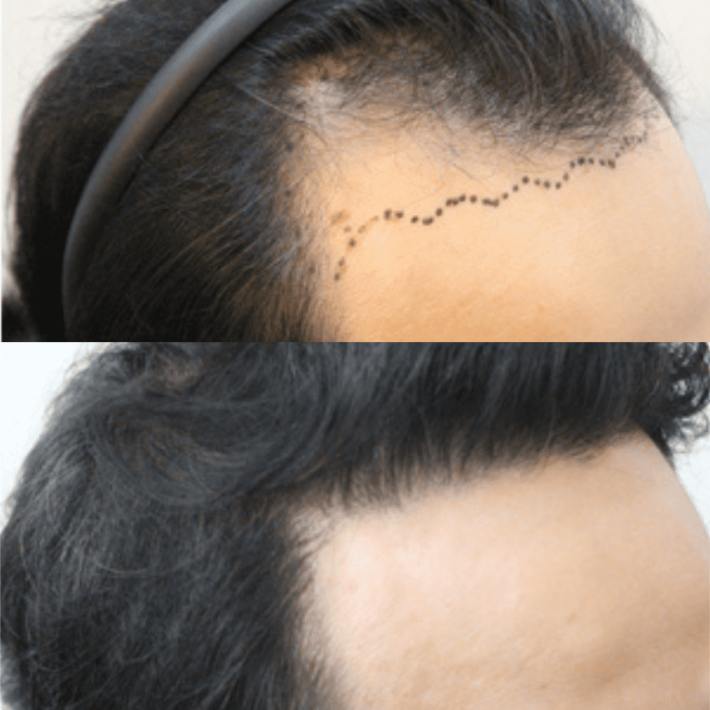 Celebrity Hair Transplant Stories_ Inspiration and Insights in Korea