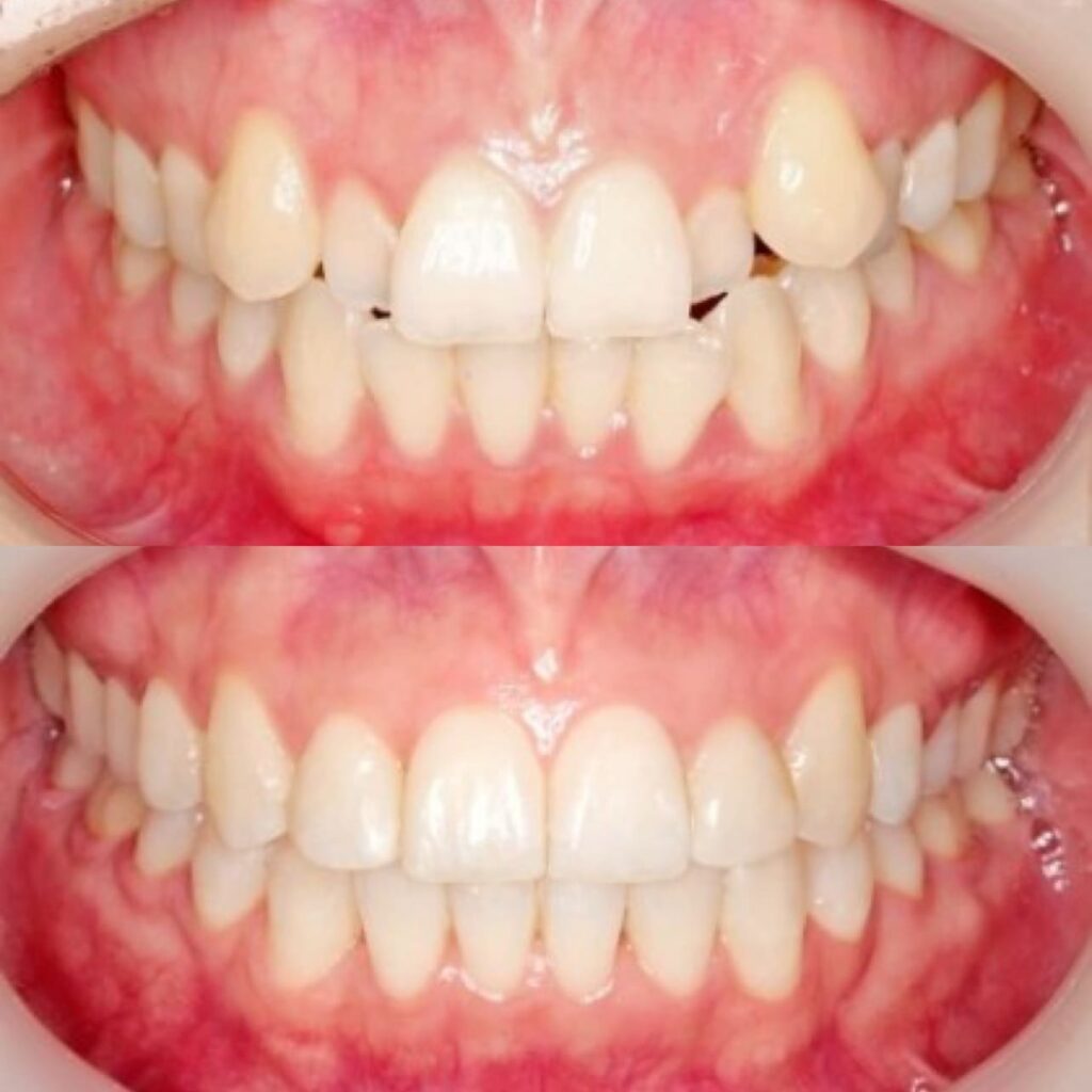 Ceramic braces on teeth in Korea