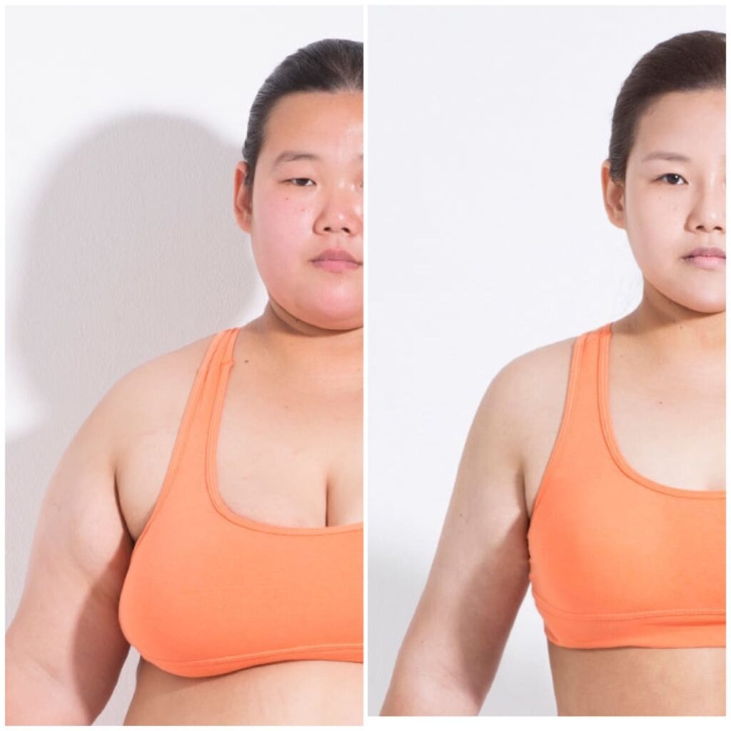 Changes After Arm Liposuction in Korea