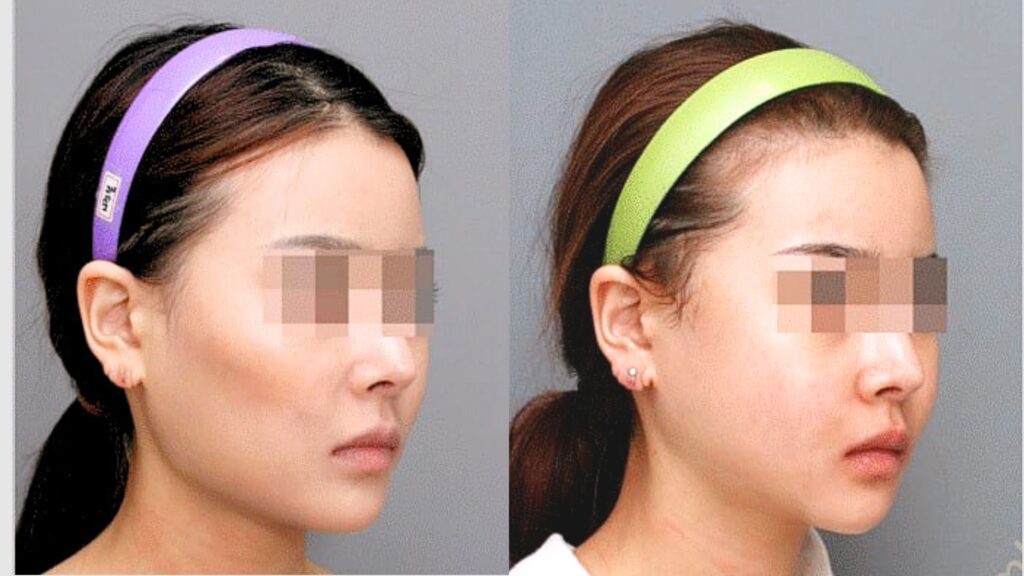 Changing Jaw Shape for Visual Grace in Korea