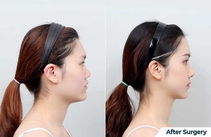 Changing Looks Through Chin Correction in Korea