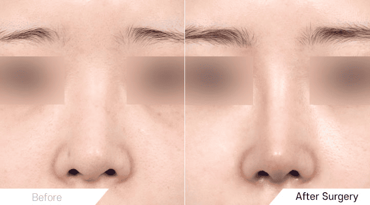 Changing Nose Shape_ Modern Rhinoplasty Methods in Korea