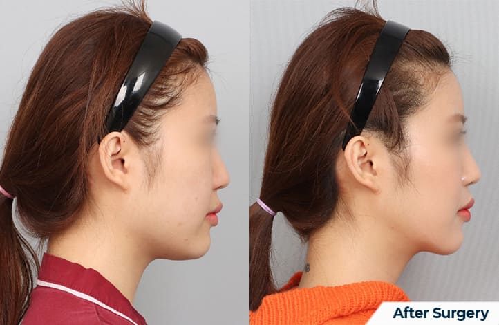 Cheek Correction for the Perfect Profile in Korea