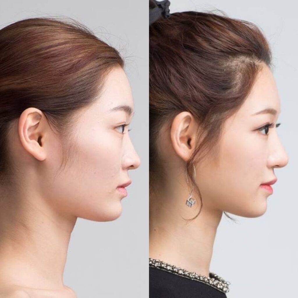 Cheek Reduction Surgery_ Before and After in Korea