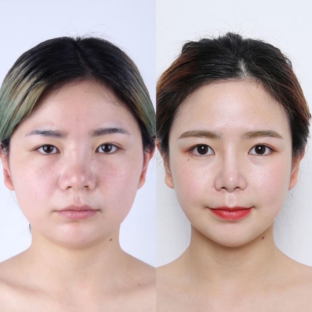 Cheek Transformation Without Implants in Korea