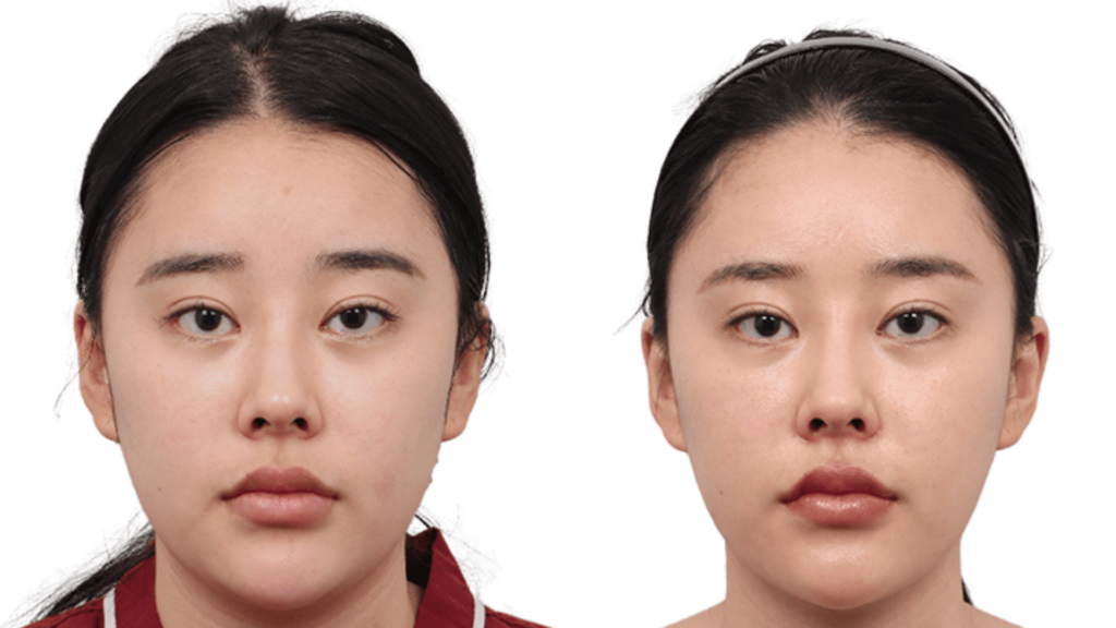 Cheekbones thread lift_ effect in Korea