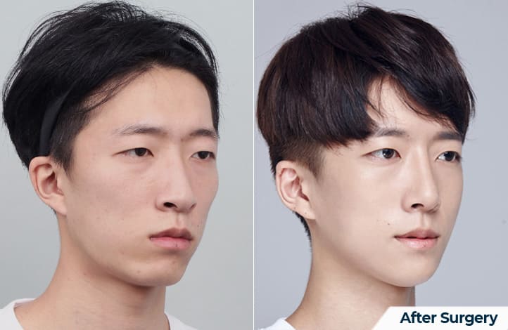 Chin Augmentation Before and After in Korea