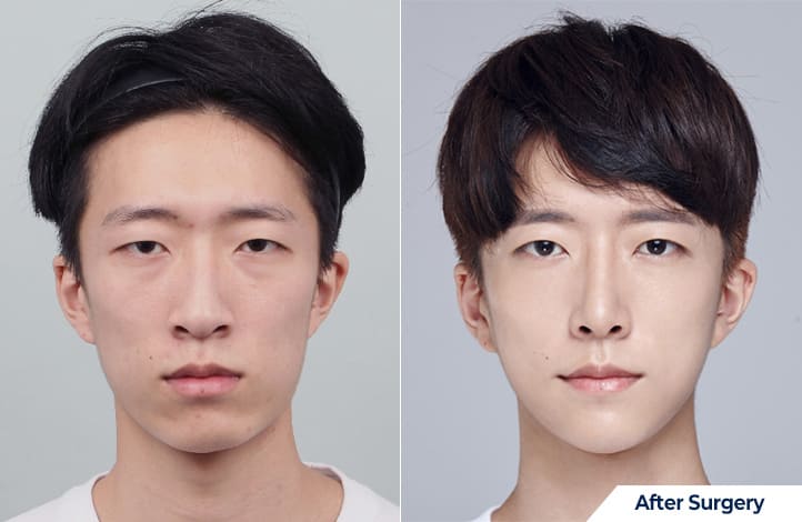 Chin Augmentation Results in Korea