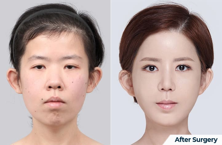 Chin Before and After Correction in Korea