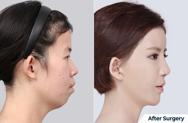 Chin Enhancement Procedure in Korea