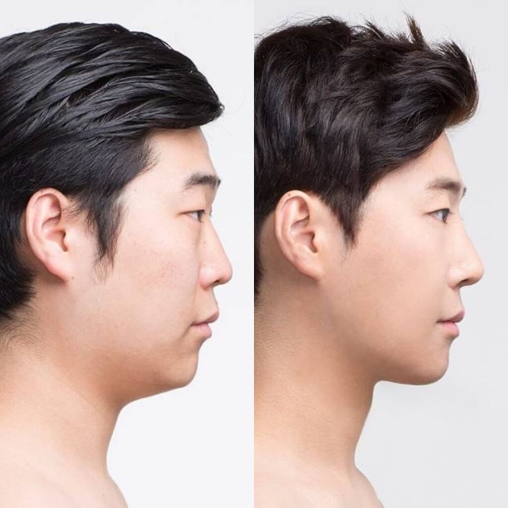 Chin Implants for Enhancement in Korea