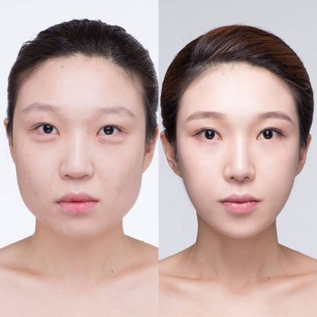 Chin Plastics for the Ideal Face Silhouette in Korea