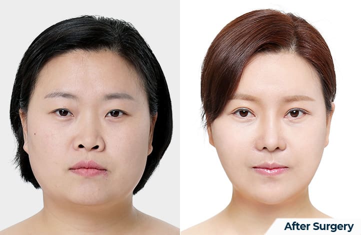 Chin Reduction_ Steps to Perfection in Korea