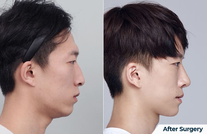 Chin Surgery_ Photo Outcomes in Korea