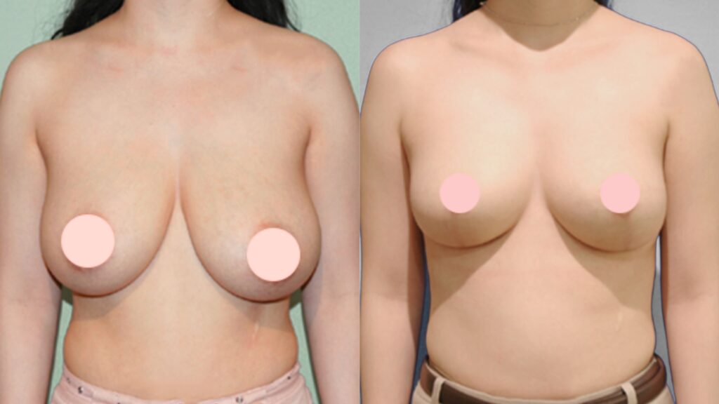 Choosing a Breast Reduction Technique