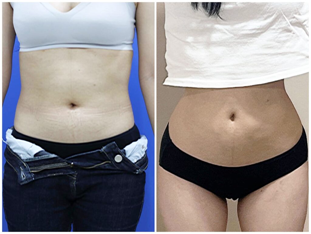 Choosing a Clinic for Abdominal Liposuction in Korea