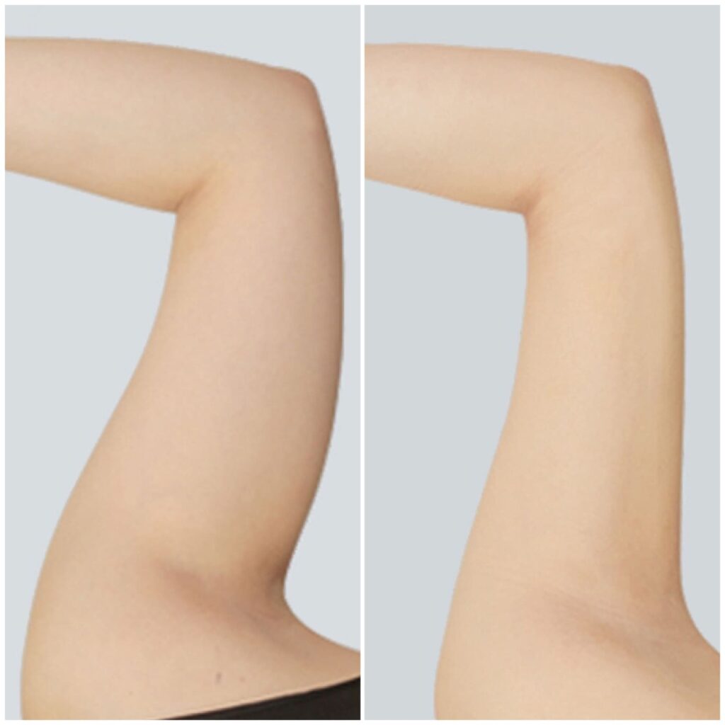 Choosing a Clinic for Arm Liposuction in Korea