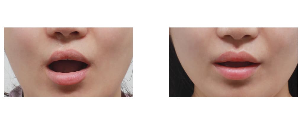 Choosing a Lip Augmentation Method in Korea