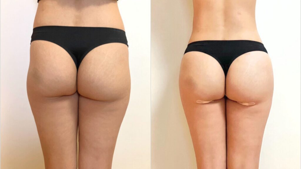 Choosing a Surgeon for Buttock Lipofilling in Korea