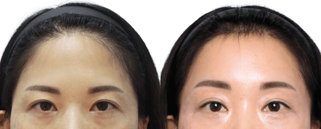 Choosing a Surgeon for Forehead Lift in Korea