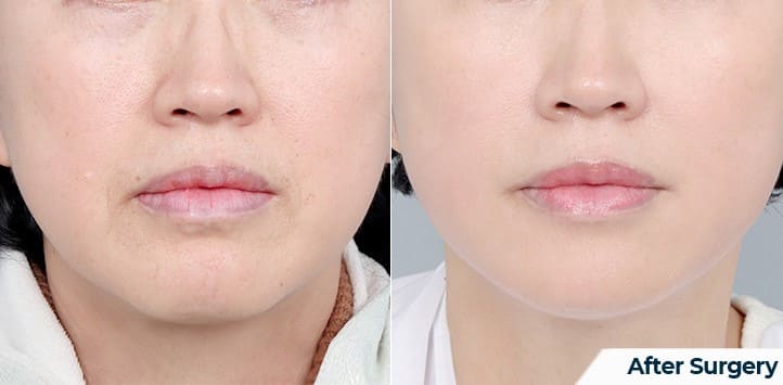 Choosing the Right Clinic for Face Lifting in Korea