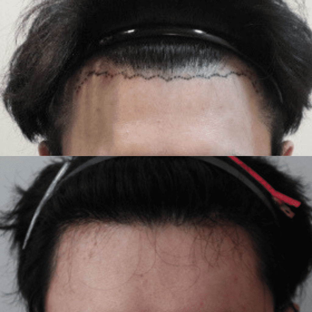 Choosing the Right Hair Transplant Clinic in Korea