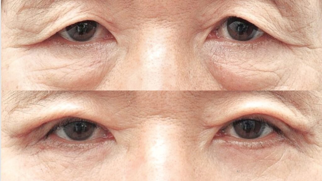 Circular Blepharoplasty Cost Guide