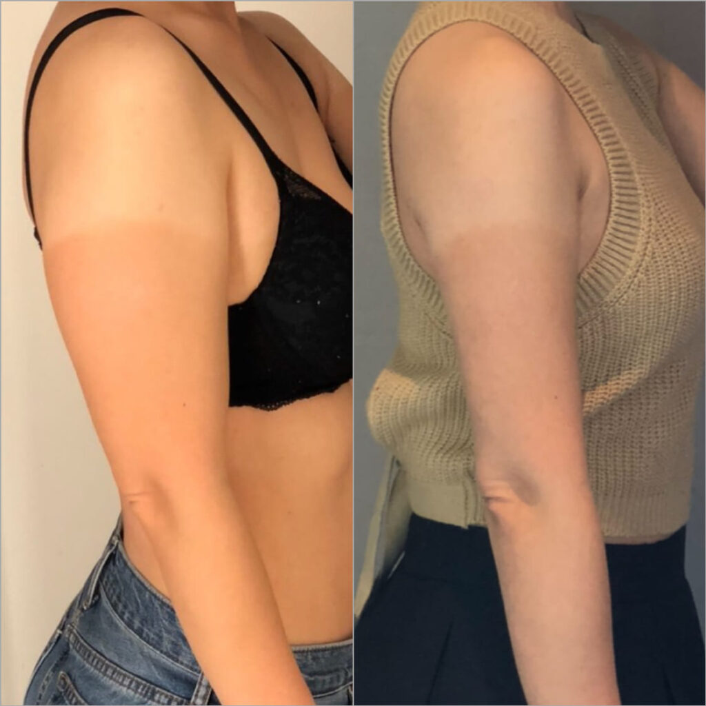 Client Photos of Arm Liposuction in Korea