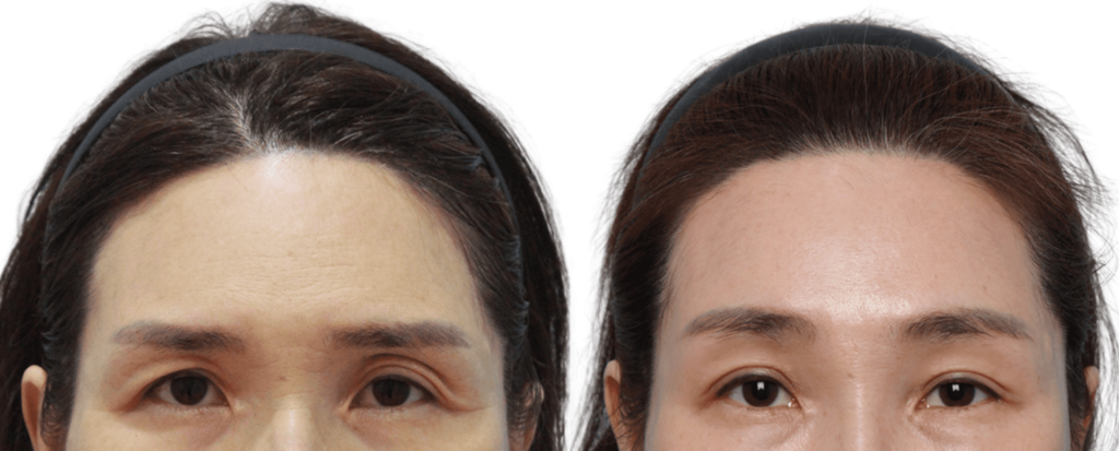 Combined Face and Forehead Lift in Korea