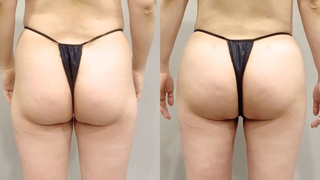 Combined Operations_ Lipofilling and Buttock Augmentation in Korea