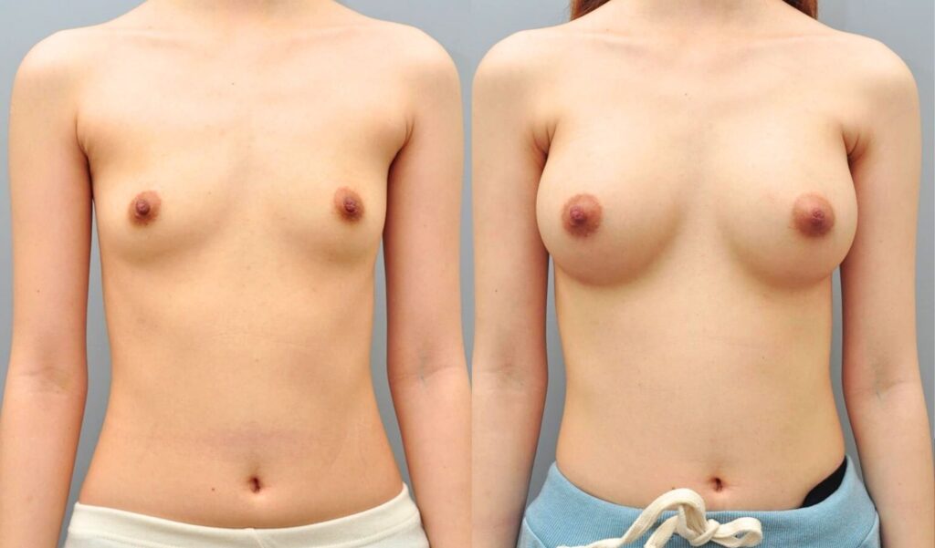 Comparing Breast Augmentation Techniques in Korea