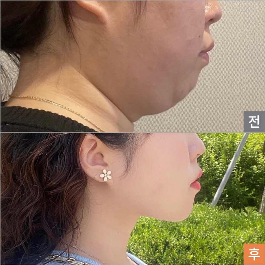 Comparing Face Liposuction and Fillers in Korea