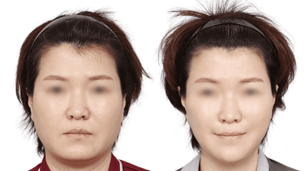 Comparing thread lift and fillers in Korea