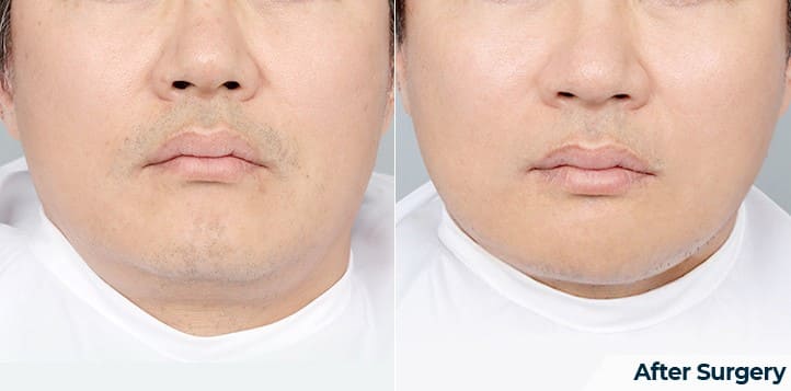 Comparison of Face Lifting Methods in South Korea