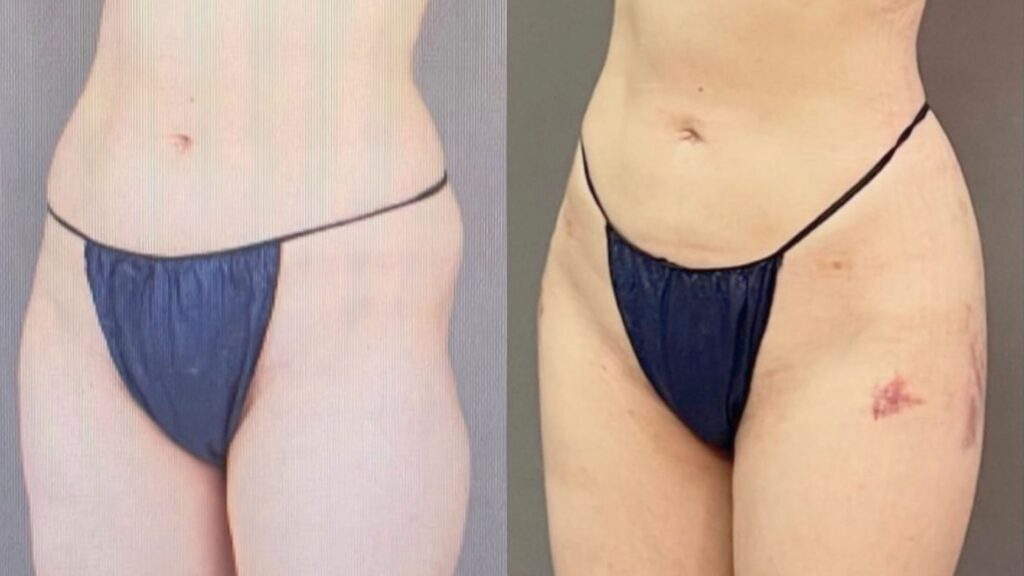 Comprehensive Approach to Buttock Enlargement_ Lipofilling and Fitness