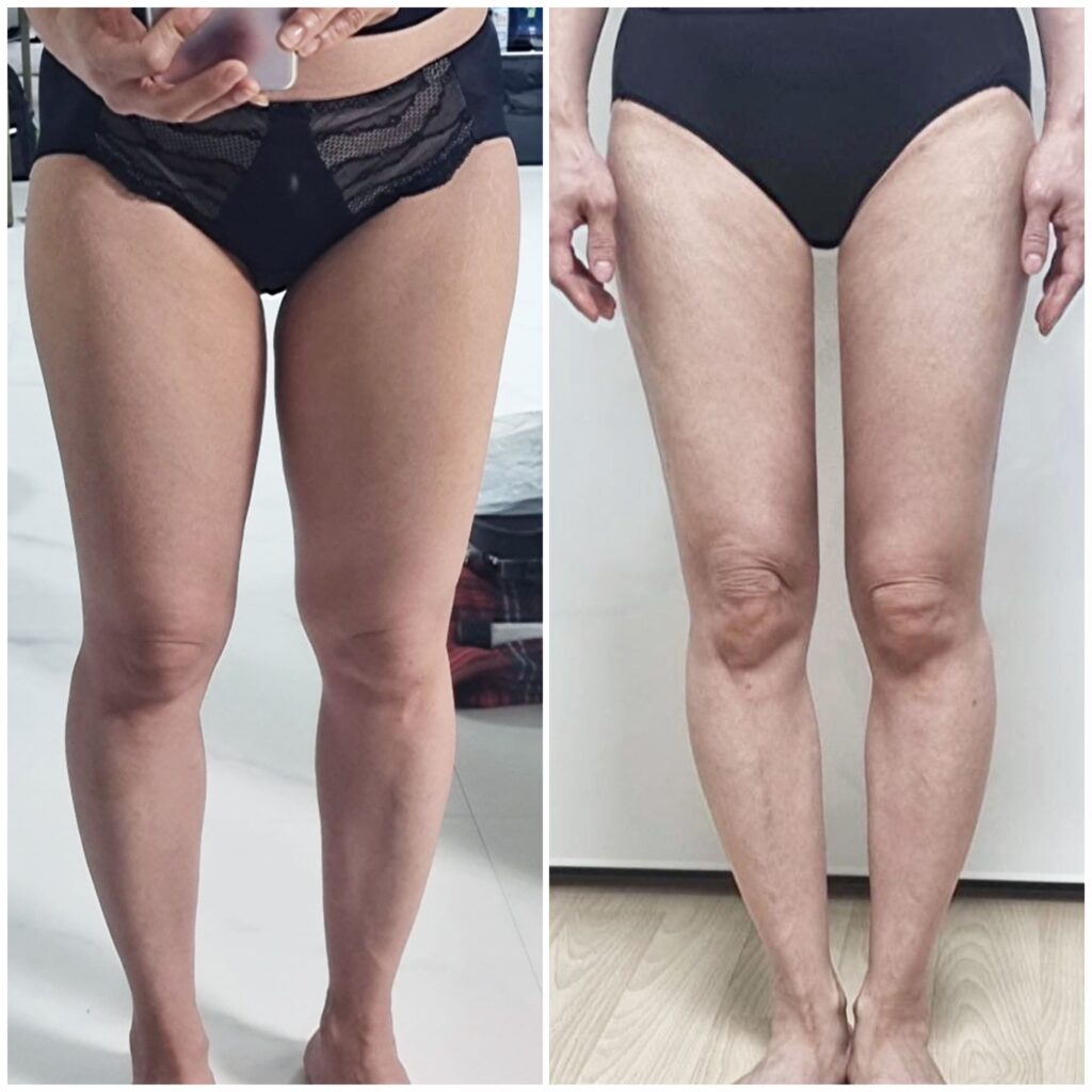 Comprehensive Approach to Leg Liposuction in Korea