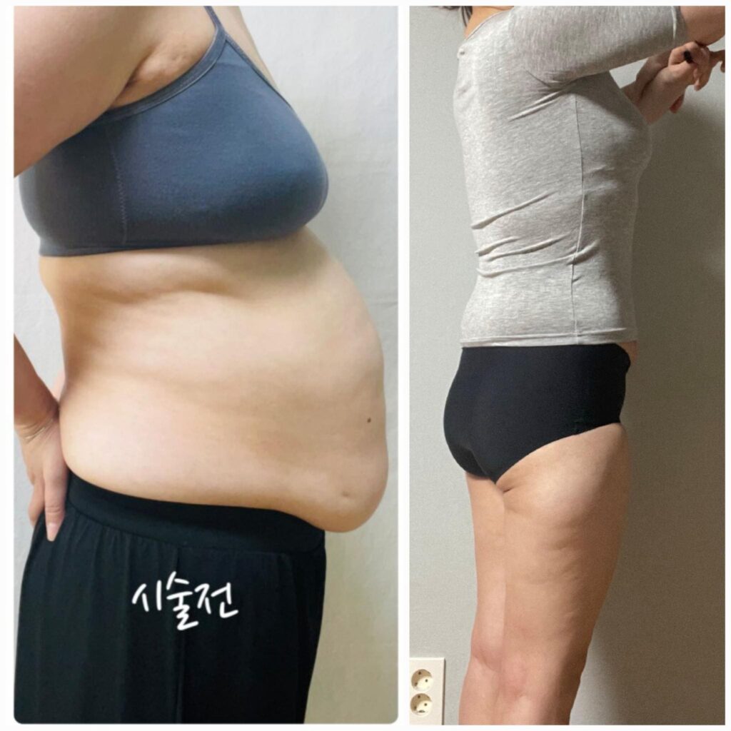 Compression Garments after Abdominal Liposuction in Korea