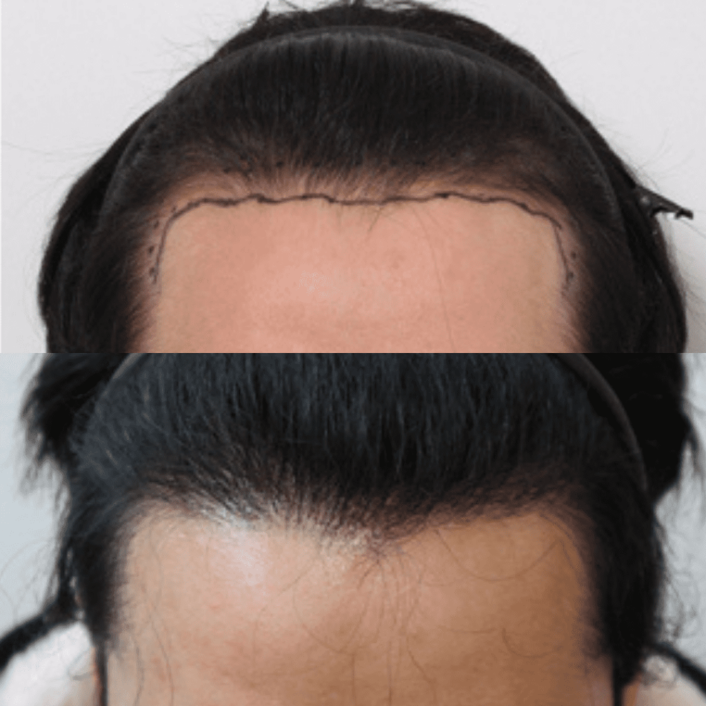 Coping with Emotional Impact of Hair Loss in Korea