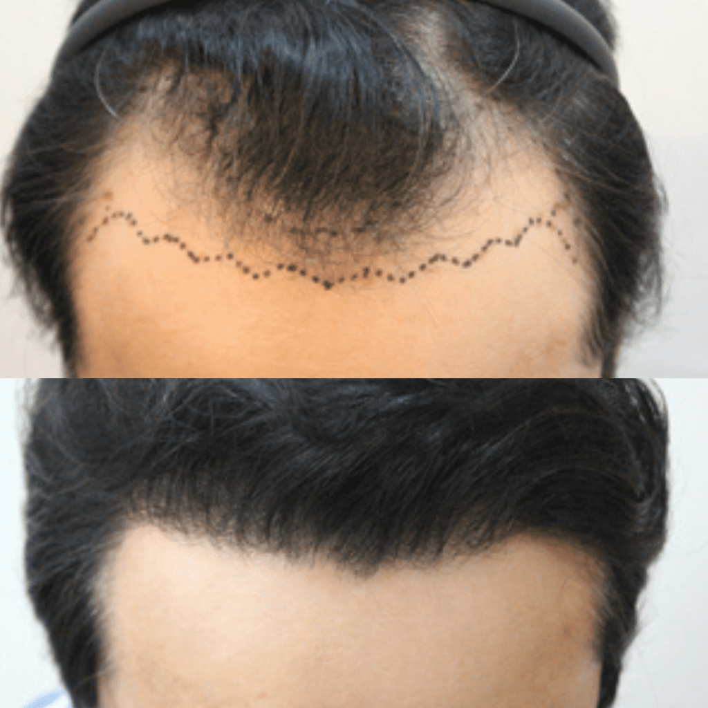 Coping with Hair Loss_ Options and Solutions in Korea