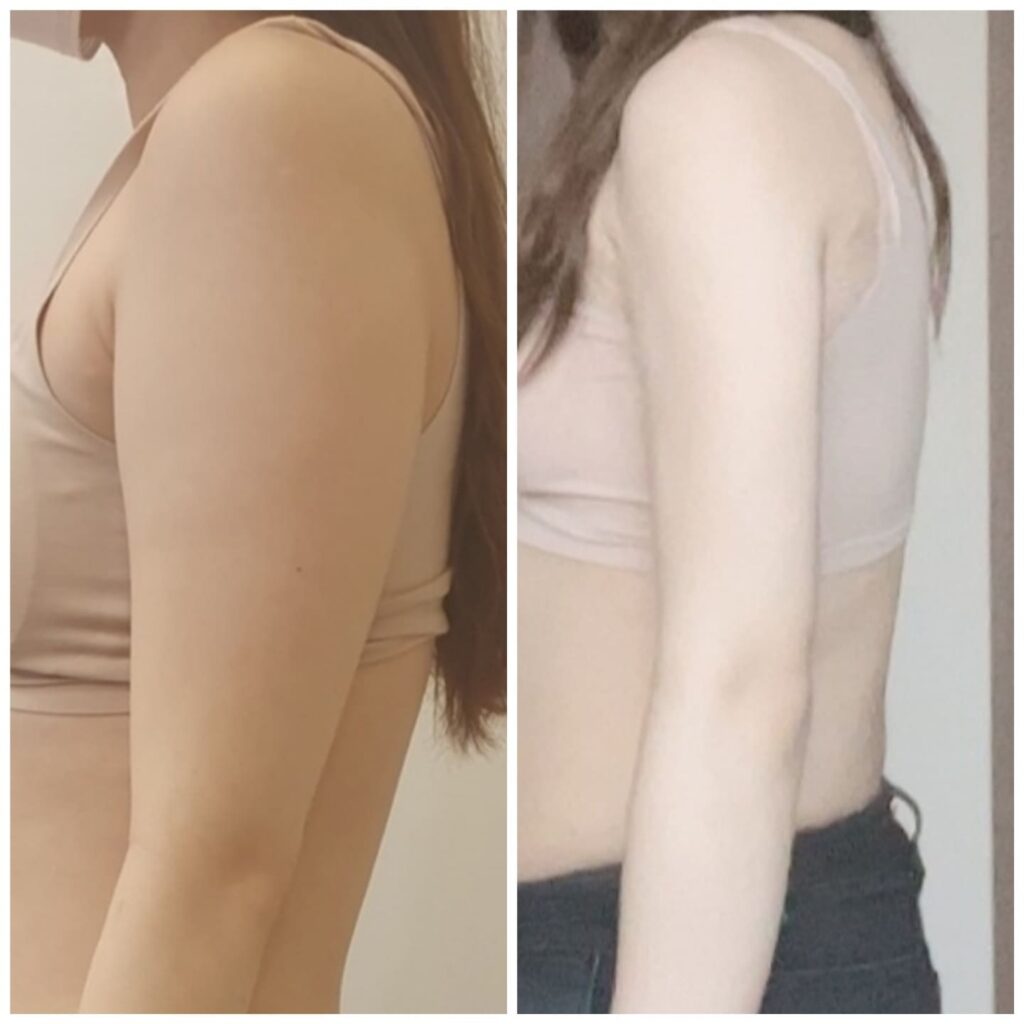 Cost of Arm Liposuction in Korea