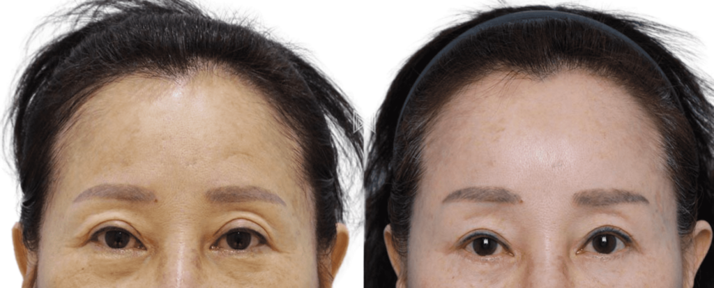 Cost of Forehead Lift in Korea