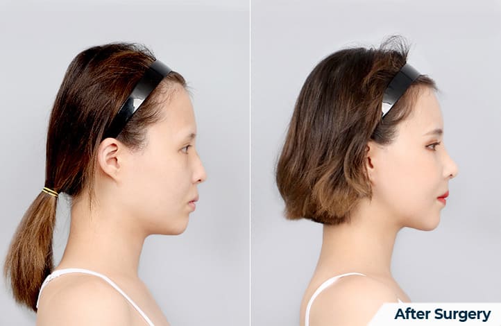 Creating the Perfect Profile with Cheek Surgery in Korea