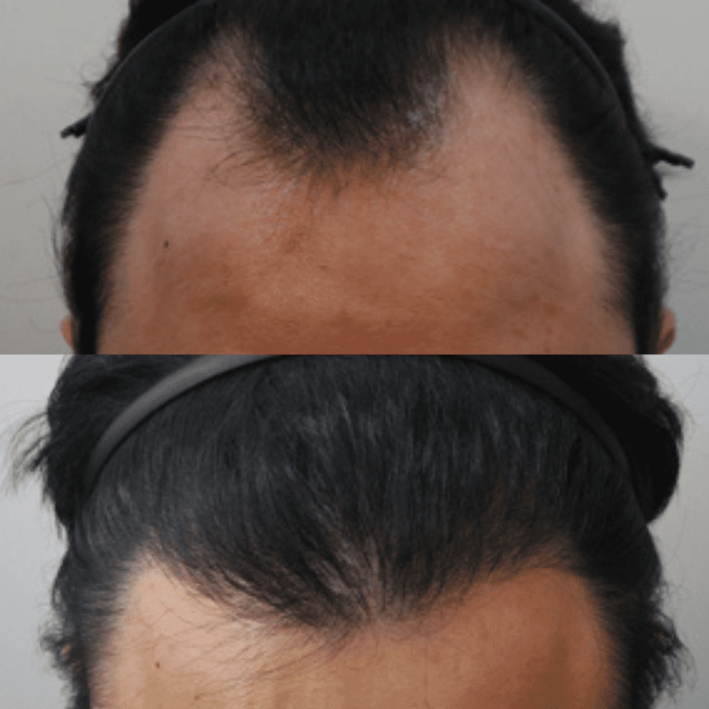 Debunking Common Hair Transplant Myths in Korea